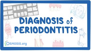 Diagnosis of Periodontitis [upl. by Lajib]