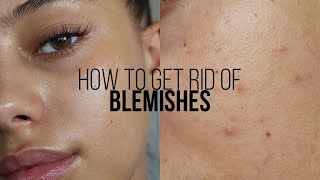 HOW TO GET RID OF BLEMISHES IN 3 DAYS  Jessicvpimentel [upl. by Nodarb]