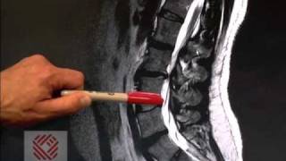 Low Back Pain Part 8 Spinal Stenosis [upl. by Bonita]