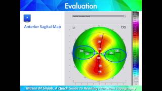 A Quick Guide to Reading Corneal Topography Part 1 [upl. by Asnerek]