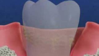 Periodontal Disease amp Treatment [upl. by Croom]