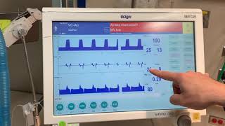 Introduction to a Drager Ventilator [upl. by Margit581]