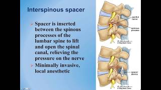 Lumbar Spinal Stenosis  Diagnosis and Treatment Options [upl. by Avalsorim]