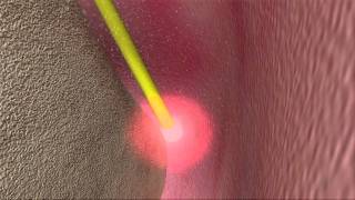 Laser Periodontal Therapy  WPT™ Animation [upl. by Nosyarg]