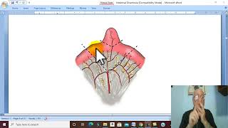 Intestinal Disorders in Arabic 7  Meckels Diverticulum   by Dr Wahdan [upl. by Napier]