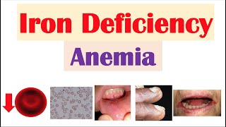 IronDeficiency Anemia Overview  Causes Pathophysiology Signs amp Symptoms Diagnosis Treatment [upl. by Puiia]