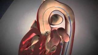 Fluoroscopy and Animation of the TAVI Procedure  NEJM [upl. by Monahon]