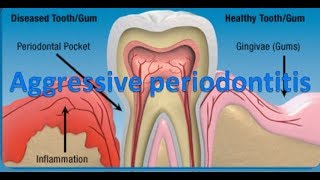 Aggressive periodontitis [upl. by Odlanyer950]