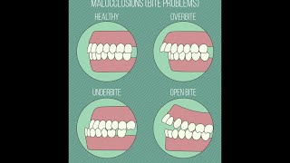 Different Types of Malocclusions [upl. by Azarcon]