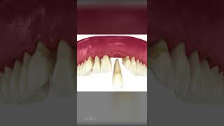 Understanding Periodontitis Causes Symptoms and Treatment [upl. by Renmus]