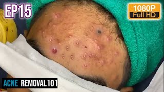 Cystic Acne Extraction 20mn  Acne treatment by ACNEREMOVAL101 [upl. by Wayolle]