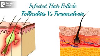 Infected hair follicle What to do Causes Location amp TreatmentDr Rasya Dixit  Doctors Circle [upl. by Milone]