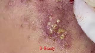 Pimple Removal and Acnes Treatment  BBeauty 07 [upl. by Gerger383]