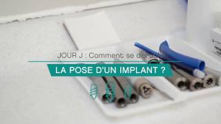 Comment se déroule la pose dun implant [upl. by Mathis]