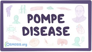 Pompe disease  causes symptoms diagnosis treatment pathology [upl. by Gerek604]