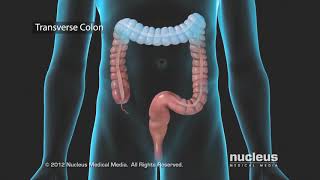 Colon Problems Diverticular Disease [upl. by Sessilu]