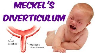 Meckels Diverticulum [upl. by Ursel]