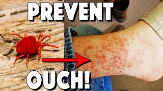 What Are Chiggers How To Treat Bites And How To Prevent [upl. by Kaehpos]