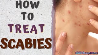 HOW TO TREAT SCABIESscabies treatment at home [upl. by Mikaela]