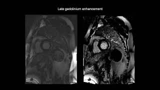 How to assess myocarditis with the help of cardiac MRI CMR [upl. by Keegan]