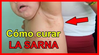 Brote de SARNA en Cuba 😖 Cómo tratar y CURAR la piel SIN MEDICINAS ✅ [upl. by Acceb]