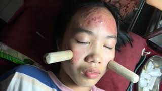 Introduction about inflammatory acne and how to solve it PART 1  official video  742019 [upl. by Ajim648]