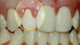 Periodontal Disease amp Treatment [upl. by Sugar805]