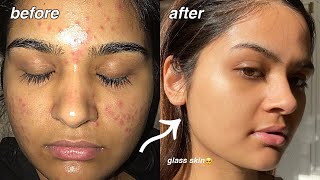 how i cleared my acne FOR GOOD something finally worked [upl. by Siraj]