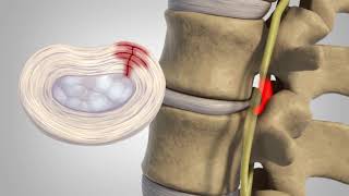 Herniated Disc  Patient Education [upl. by Yennek]