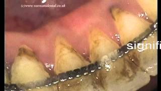 Non Surgical Periodontal Treatment [upl. by Eillam]