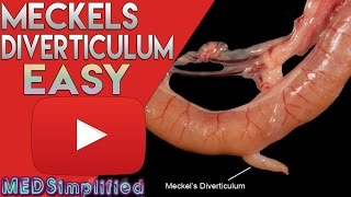 Meckels Diverticulum Made Easy [upl. by Presley]