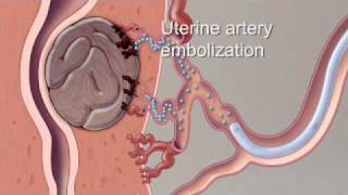 What to Expect After CATARACT SURGERY [upl. by Ferd389]