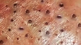 Deep blackhead extraction Cystic acne amp pimple popping 86 [upl. by Philbrook]