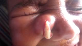 Abscess On Side Of Nose [upl. by Lunneta]