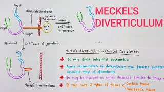 Meckels Diverticulum With Clinical Correlations [upl. by Carrissa]