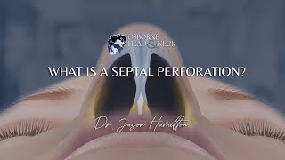 What is a septal perforation [upl. by Franzen]