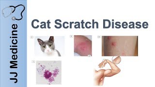 Cat Scratch Disease  Causes Symptoms and Treatment [upl. by Anay]