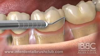 Periodontal disease causes and treatment [upl. by Alakam]