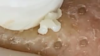 Deep blackhead extraction Cystic acne amp pimple popping 72 [upl. by Hamish]