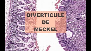 Diverticule de Meckel  Pathologie [upl. by Barbuto]