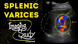 Splenic Varices  Ultrasound  Case 49 [upl. by Butte440]