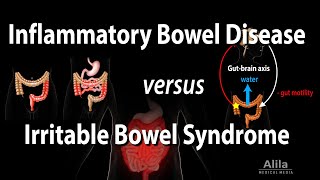 Inflammatory Bowel Disease vs Irritable Bowel Syndrome Animation [upl. by Hsoj904]