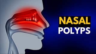 NASAL POLYPS Causes SIgns and Symptoms Diagnosis and Treatment [upl. by Leede96]