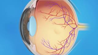 Macular Hole Vitrectomy Surgery [upl. by Amory]