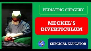 MECKELS DIVERTICULUM How To DIAGNOSE amp TREAT Pediatric Surgery [upl. by Niuqram479]