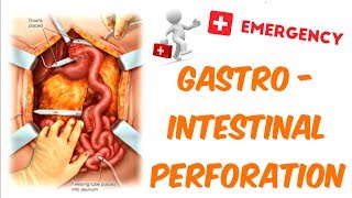 Gastrointestinal Perforation [upl. by Gnet820]