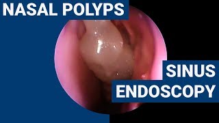 Nasal polyps  PHACON Sinus Patient Meyer [upl. by Reaht]