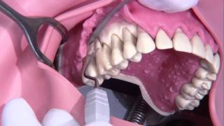 Periodontal surgery Modified Widmann flap [upl. by Clere]