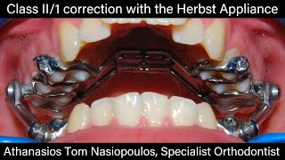 Class II correction with Herbst Appliance  Tom Nasiopoulos [upl. by Adnoma]