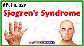 Sjogrens syndrome Usmle  Etiology  Clinical features  Diagnosis  Treatment [upl. by Alecram63]